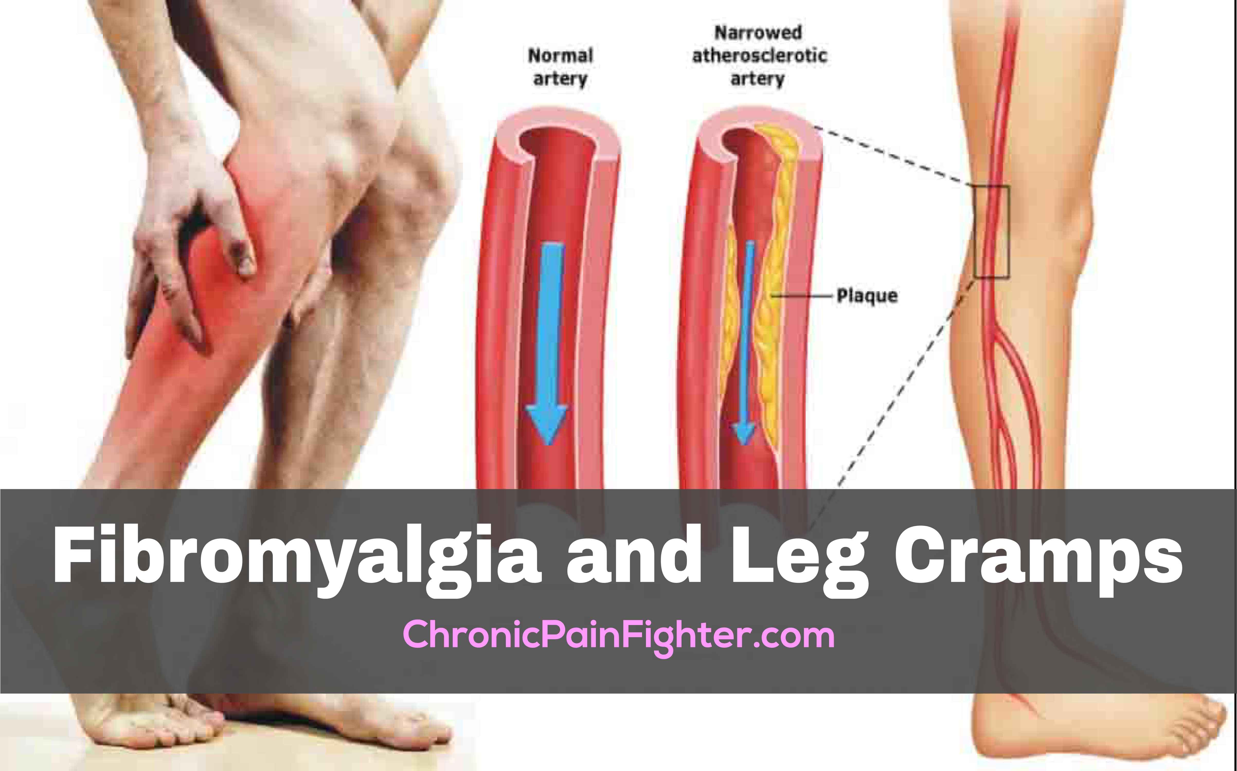 Fibromyalgia and Leg Cramps
