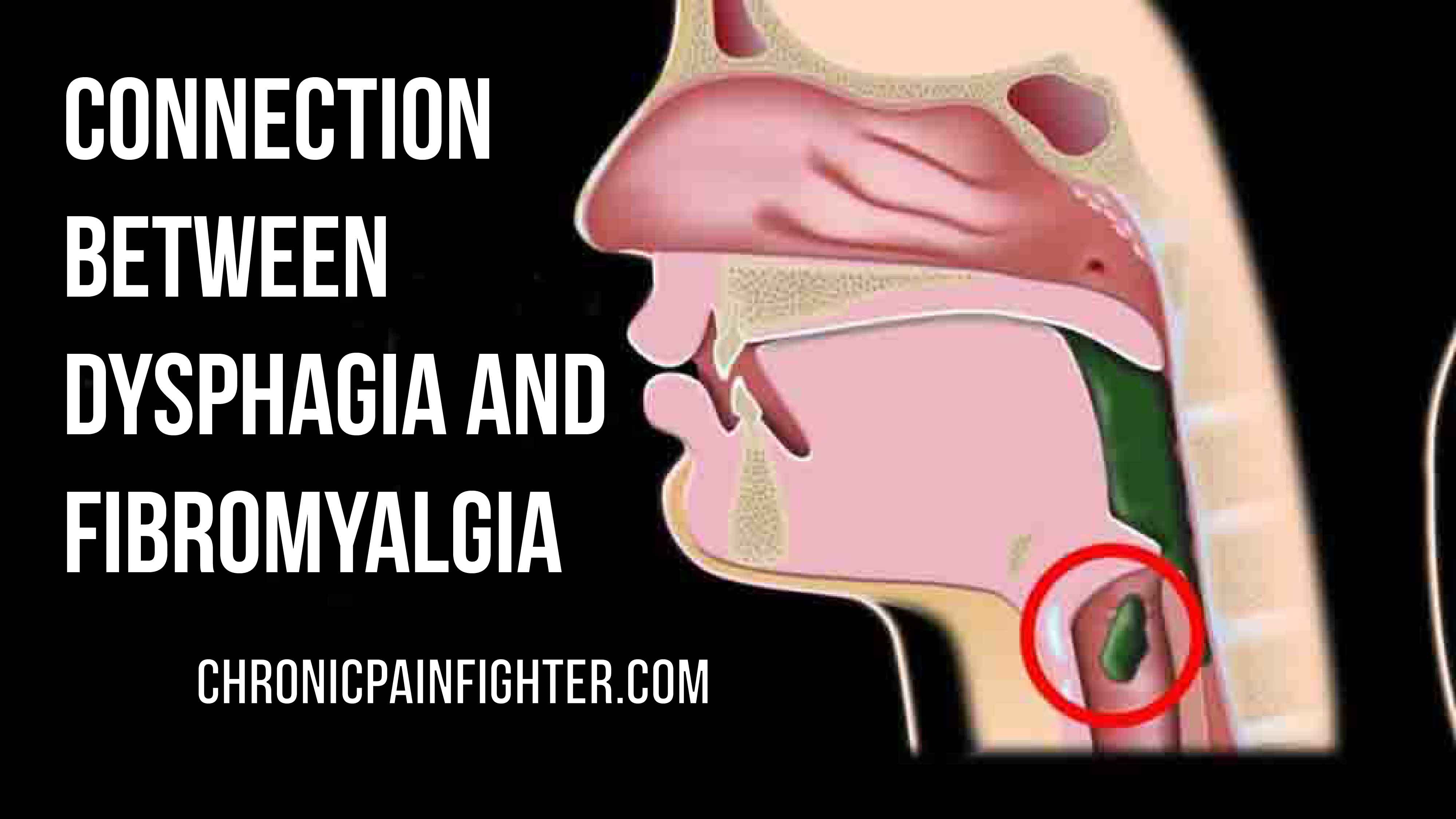 Connection between Dysphagia and Fibromyalgia