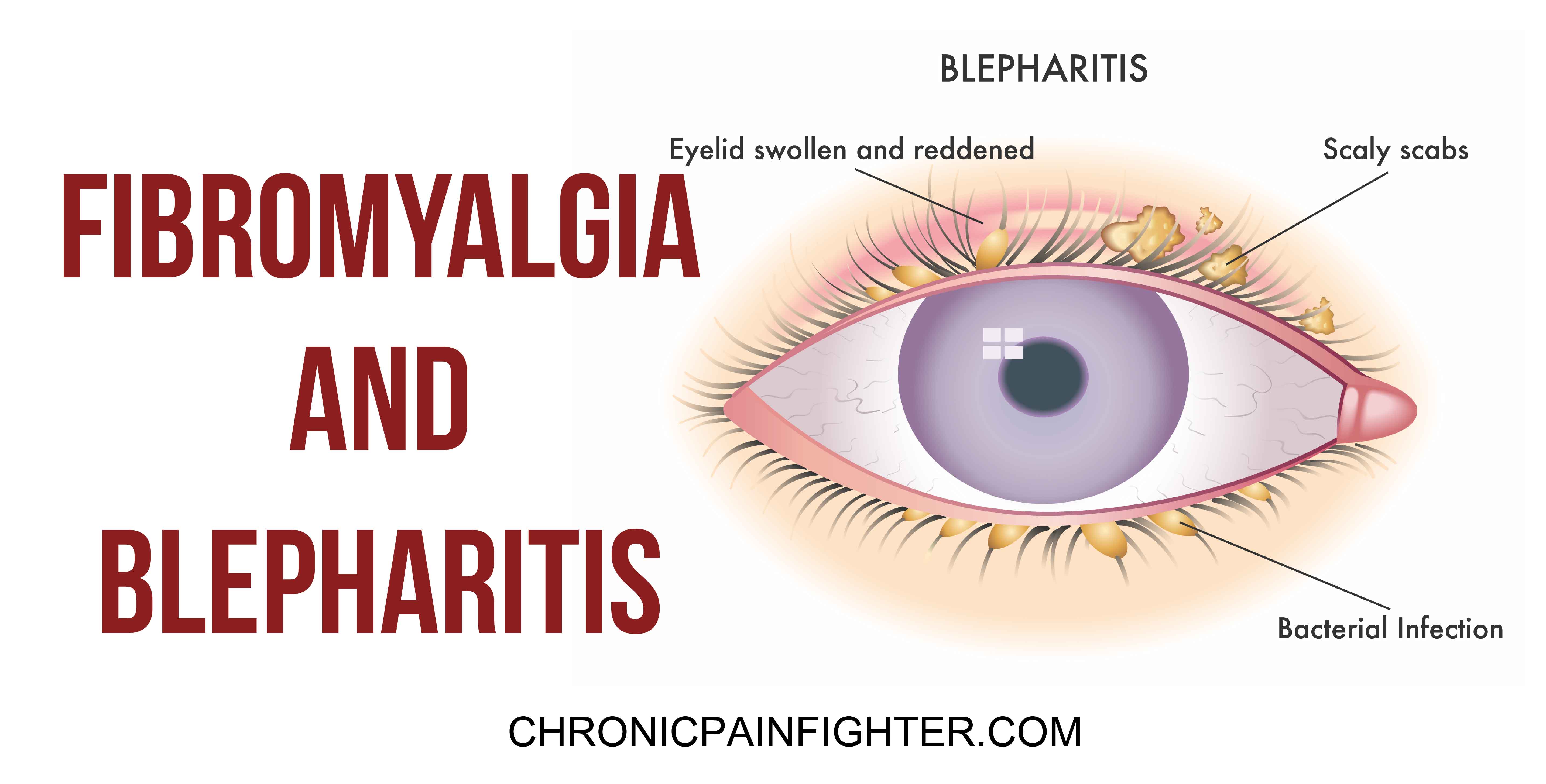 Fibromyalgia and Blepharitis