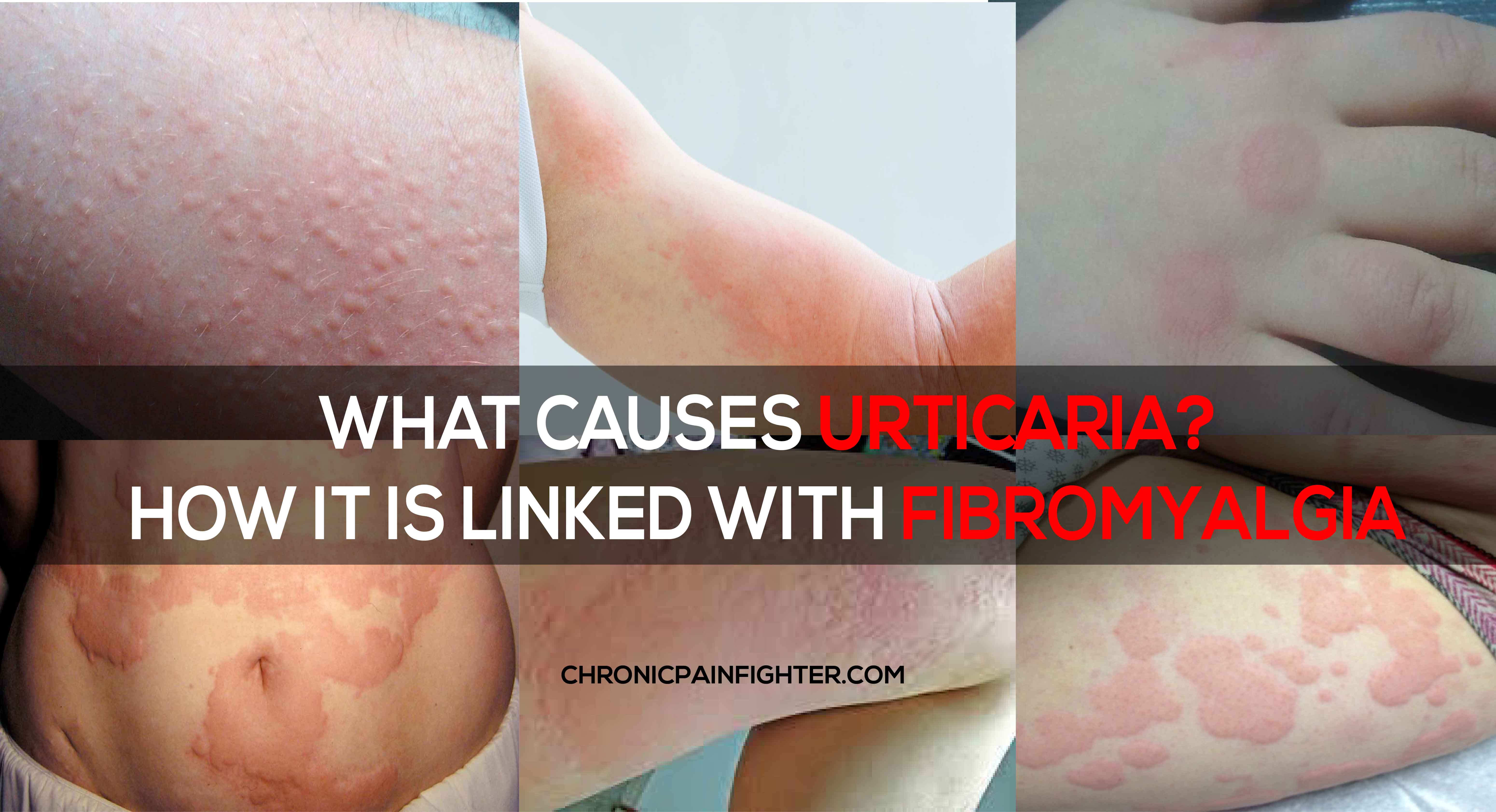 What Causes Urticaria? How It is Linked With Fibromyalgia