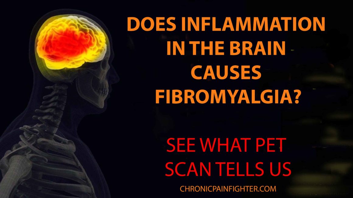 Does Inflammation in the Brain Causes Fibromyalgia? See what PET Scan Tells us