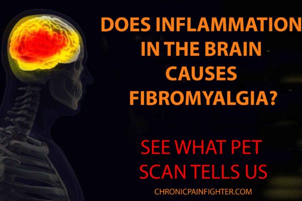 Does Inflammation in the Brain Causes Fibromyalgia? See what PET Scan Tells us