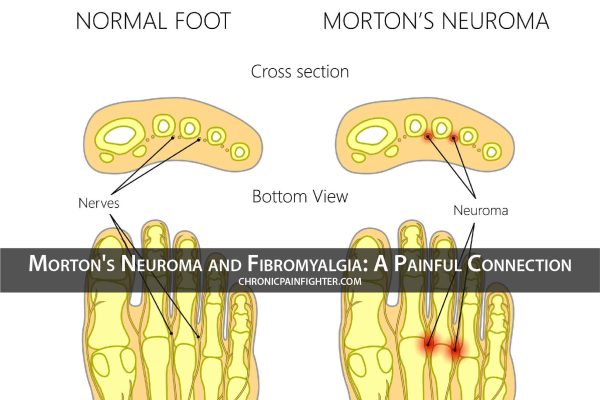 Morton’s Neuroma and Fibromyalgia: A Painful Connection